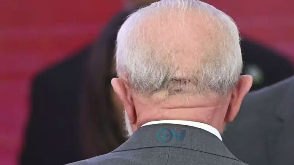 Presidente Lula passa por cirurgia para tratar sangramento no crânio após queda no banheiro